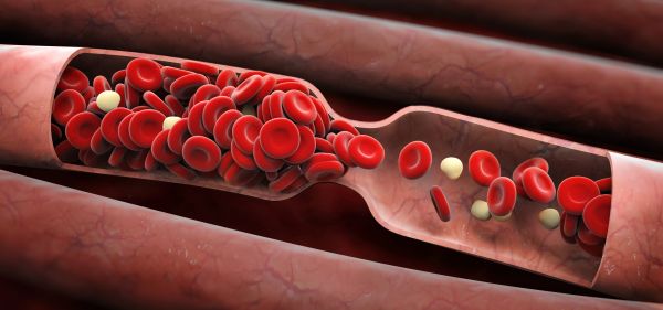 Какво е кръвен съсирек и защо може да е полезен и вреден?